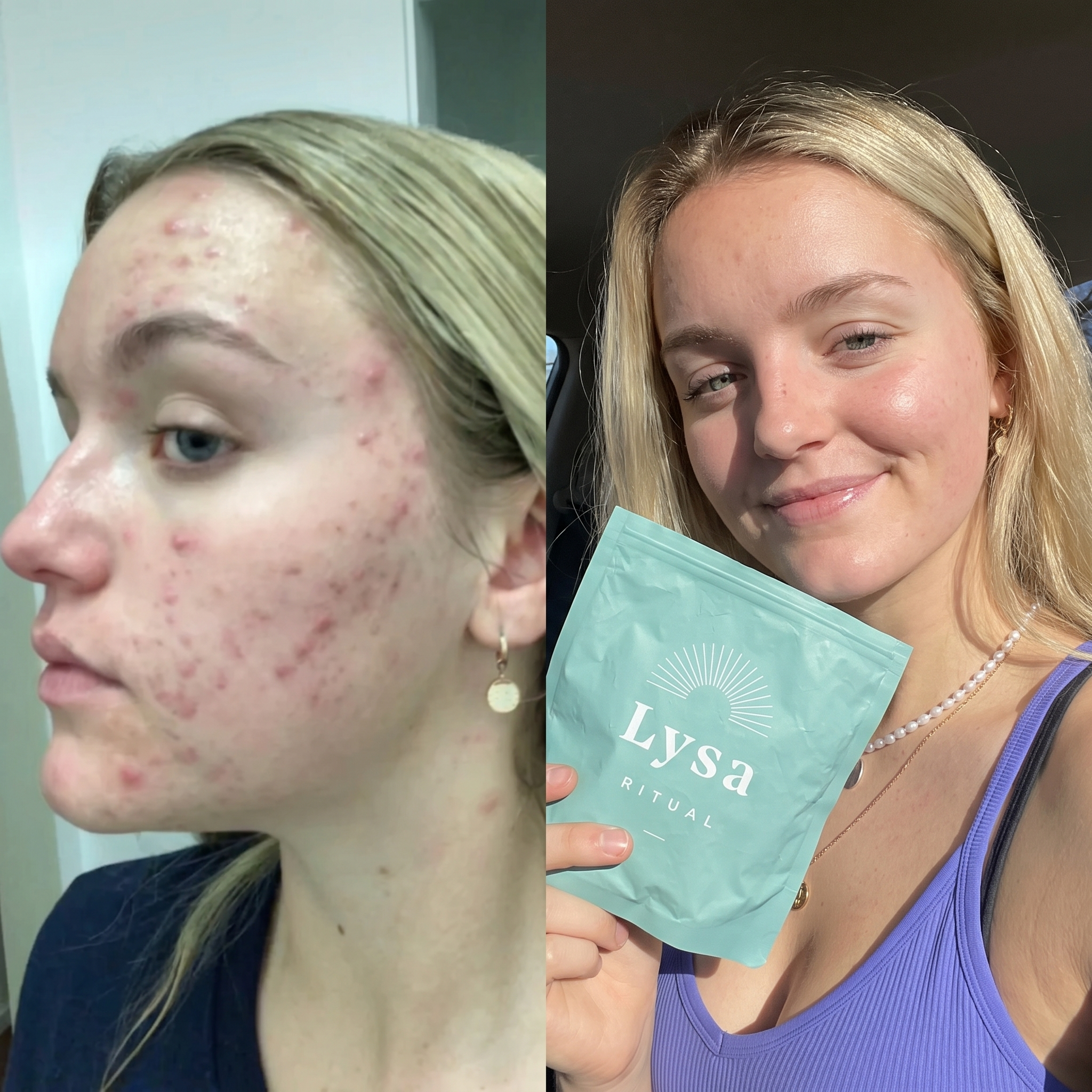 Before and after using Lysa Ritual — real teen result